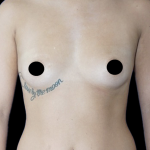 Breast Augmentation Before & After Patient #1633