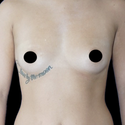 Breast Augmentation Before & After Patient #1633