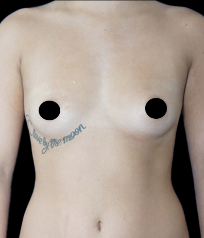 Breast Augmentation Before & After Patient #1633