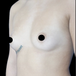 Breast Augmentation Before & After Patient #1633