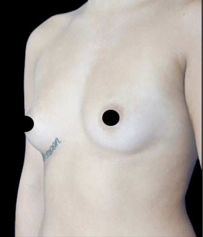 Breast Augmentation Before & After Patient #1633