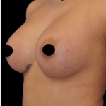 Breast Augmentation Before & After Patient #1633