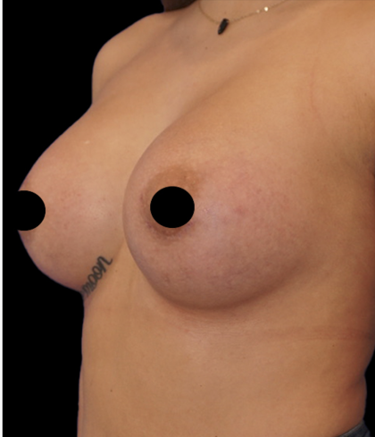 Breast Augmentation Before & After Patient #1633