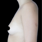 Breast Augmentation Before & After Patient #1633