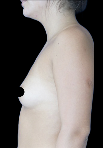Breast Augmentation Before & After Patient #1633