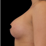 Breast Augmentation Before & After Patient #1633
