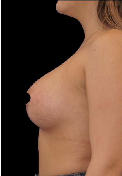 Breast Augmentation Before & After Patient #1633
