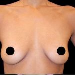 Breast Augmentation Before & After Patient #1642