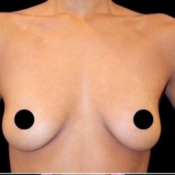 Breast Augmentation Before & After Patient #1642