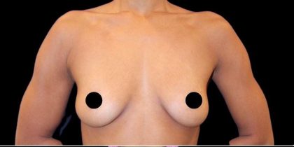 Breast Augmentation Before & After Patient #1642