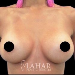 Breast Augmentation Before & After Patient #1642