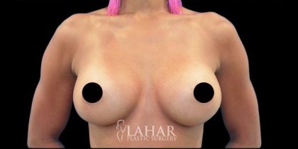 Breast Augmentation Before & After Patient #1642