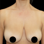Breast Lift/Reduction Before & After Patient #1667