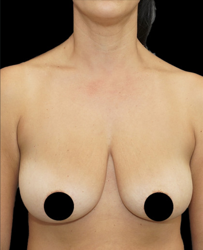 Breast Lift/Reduction Before & After Patient #1667