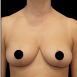 Breast Lift/Reduction Before & After Patient #1667