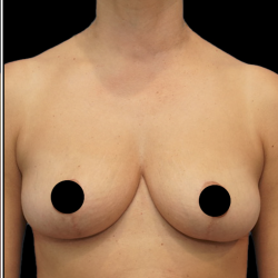 Breast Lift/Reduction Before & After Patient #1667