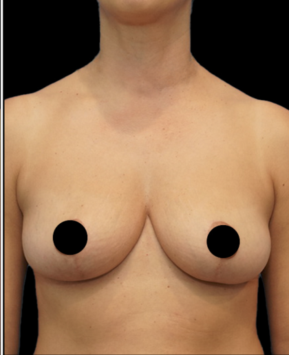 Breast Lift/Reduction Before & After Patient #1667