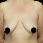 Breast Lift/Reduction Before & After Patient #1668