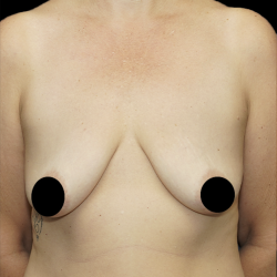 Breast Lift/Reduction Before & After Patient #1668