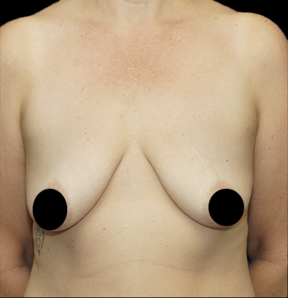Breast Lift/Reduction Before & After Patient #1668