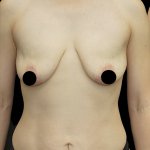 Breast Lift/Reduction Before & After Patient #1669