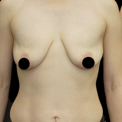 Breast Lift/Reduction Before & After Patient #1669