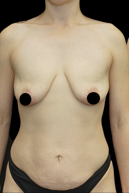 Breast Lift/Reduction Before & After Patient #1669