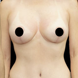 Breast Lift/Reduction Before & After Patient #1669