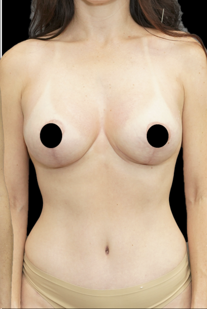 Breast Lift/Reduction Before & After Patient #1669
