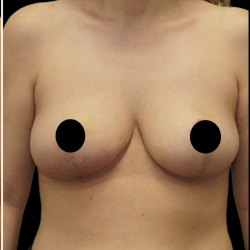 Breast Lift/Reduction Before & After Patient #1670