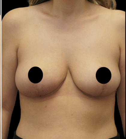 Breast Lift/Reduction Before & After Patient #1670