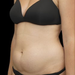 Mommy Makeover Before & After Patient #1673