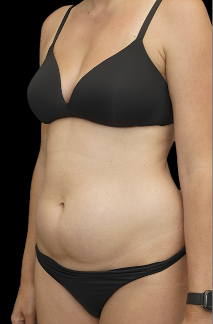 Mommy Makeover Before & After Patient #1673