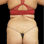 Mommy Makeover Before & After Patient #1674