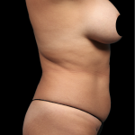 Mommy Makeover Before & After Patient #1675