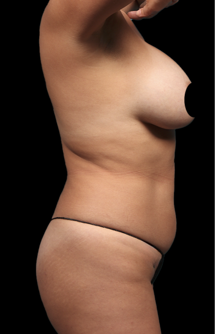 Mommy Makeover Before & After Patient #1675