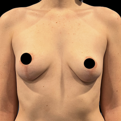 Breast Augmentation Before & After Patient #1634