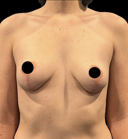 Breast Augmentation Before & After Patient #1634