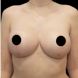 Breast Augmentation Before & After Patient #1634
