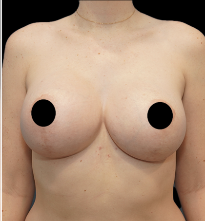 Breast Augmentation Before & After Patient #1634