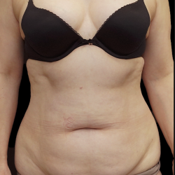 Tummy Tuck Before & After Patient #1703
