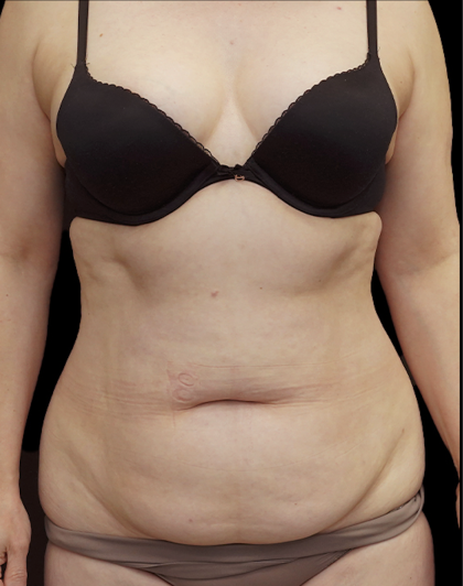 Tummy Tuck Before & After Patient #1703