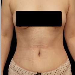 Tummy Tuck Before & After Patient #1703
