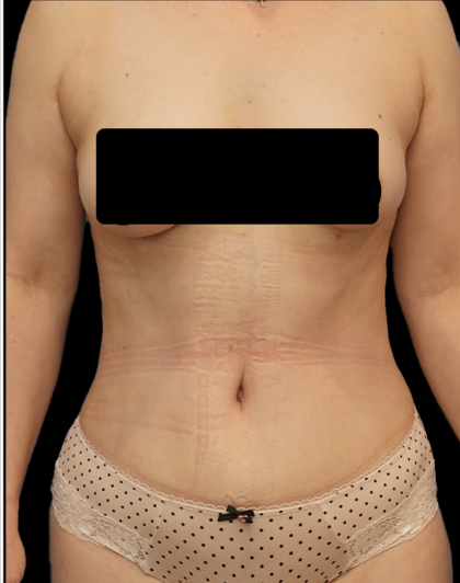 Tummy Tuck Before & After Patient #1703
