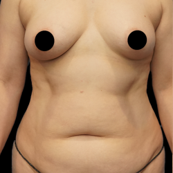 Tummy Tuck Before & After Patient #1704