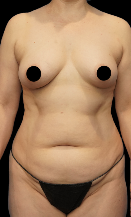 Tummy Tuck Before & After Patient #1704