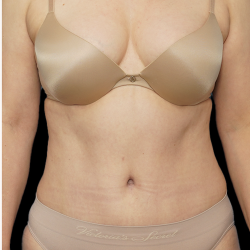 Tummy Tuck Before & After Patient #1704