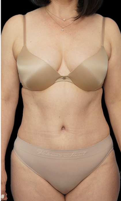 Tummy Tuck Before & After Patient #1704
