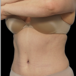 Tummy Tuck Before & After Patient #1704