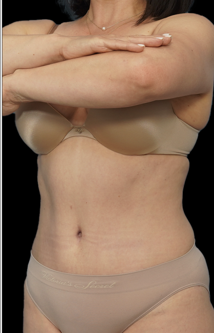 Tummy Tuck Before & After Patient #1704